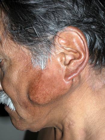 Parotid Gland Tumour at The Face Clinic