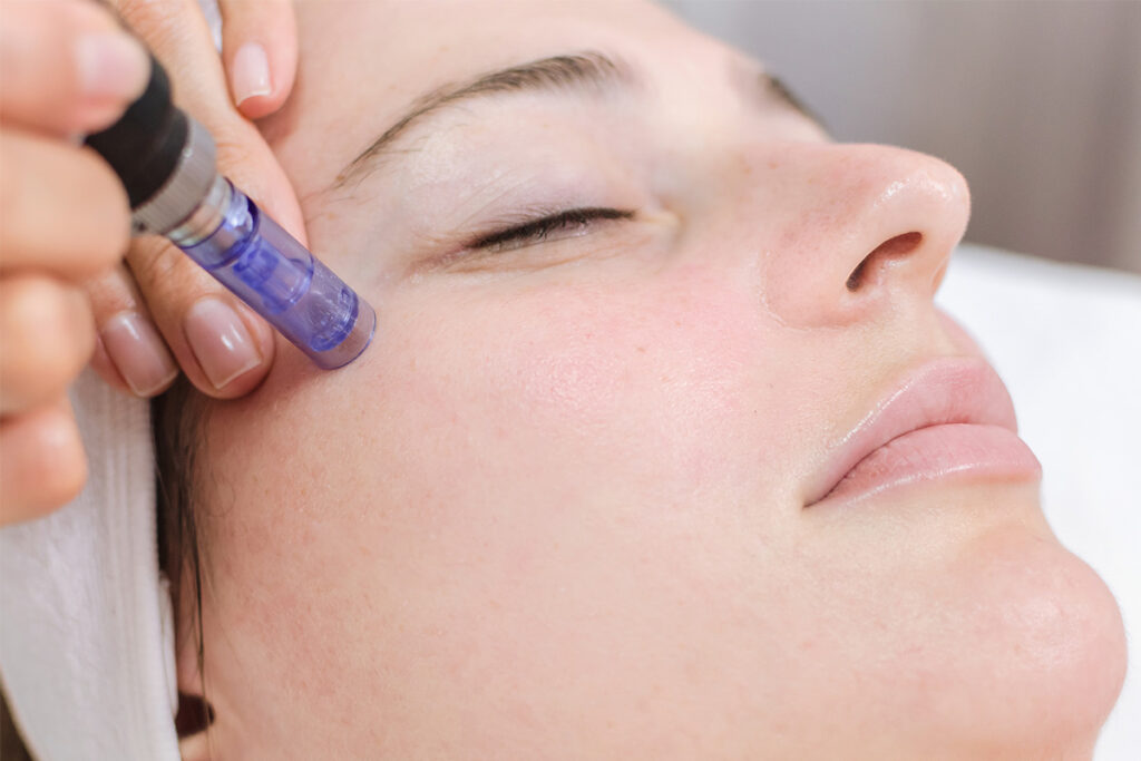 Microneedling at the Face clinic multan