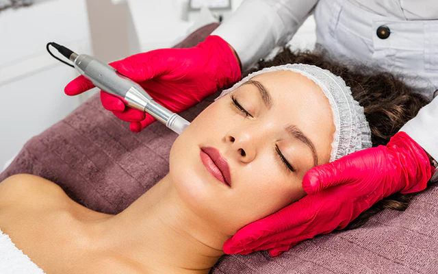 MICRONEEDLING FOR ACNE SCARS IS BEST FACIAL AESTHETC TREATMENT IN 2025