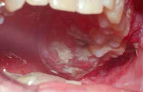 Oral Cancer at THE FACE CLINIC