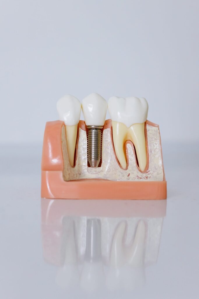 Dental implants at THE FACE CLIIC