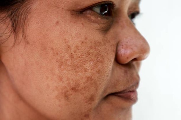 acne scars with post acne spots on face by thefaceclinicpk.com