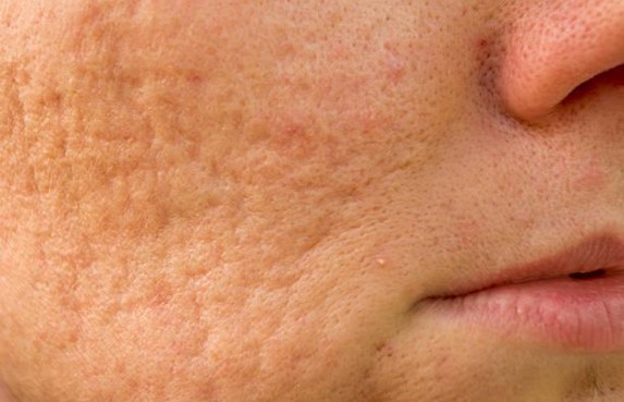 best treatment options for old acne scars