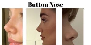 Button Nose :Type of Noses