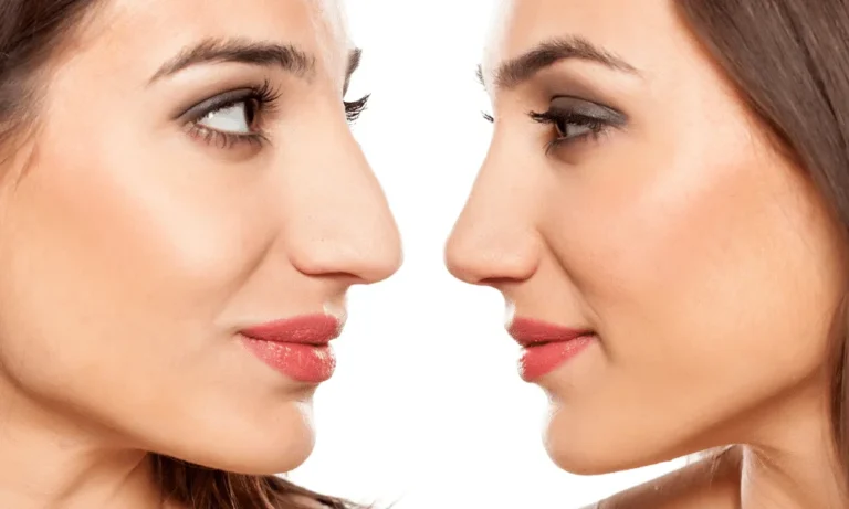 Greek Nose: Everything you Need To Know