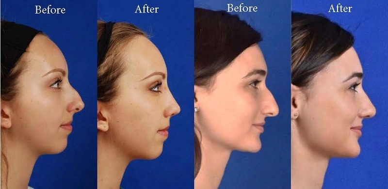 Rhinoplasty for Button Nose