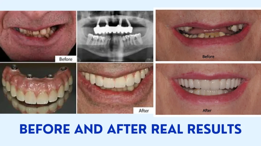 Real results after tooth implant