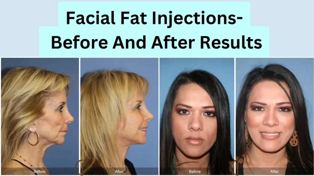 Facial Fat Injection ,Micro Grafting. Before And After Results