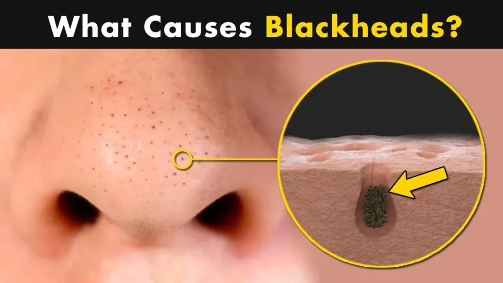 What causes black pimples?