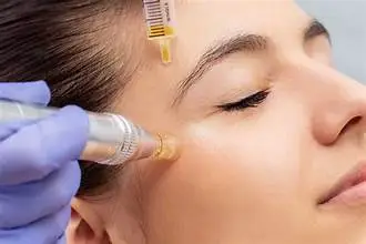 Best Treatment for Acne Scars Microneedling or Chemical Peel