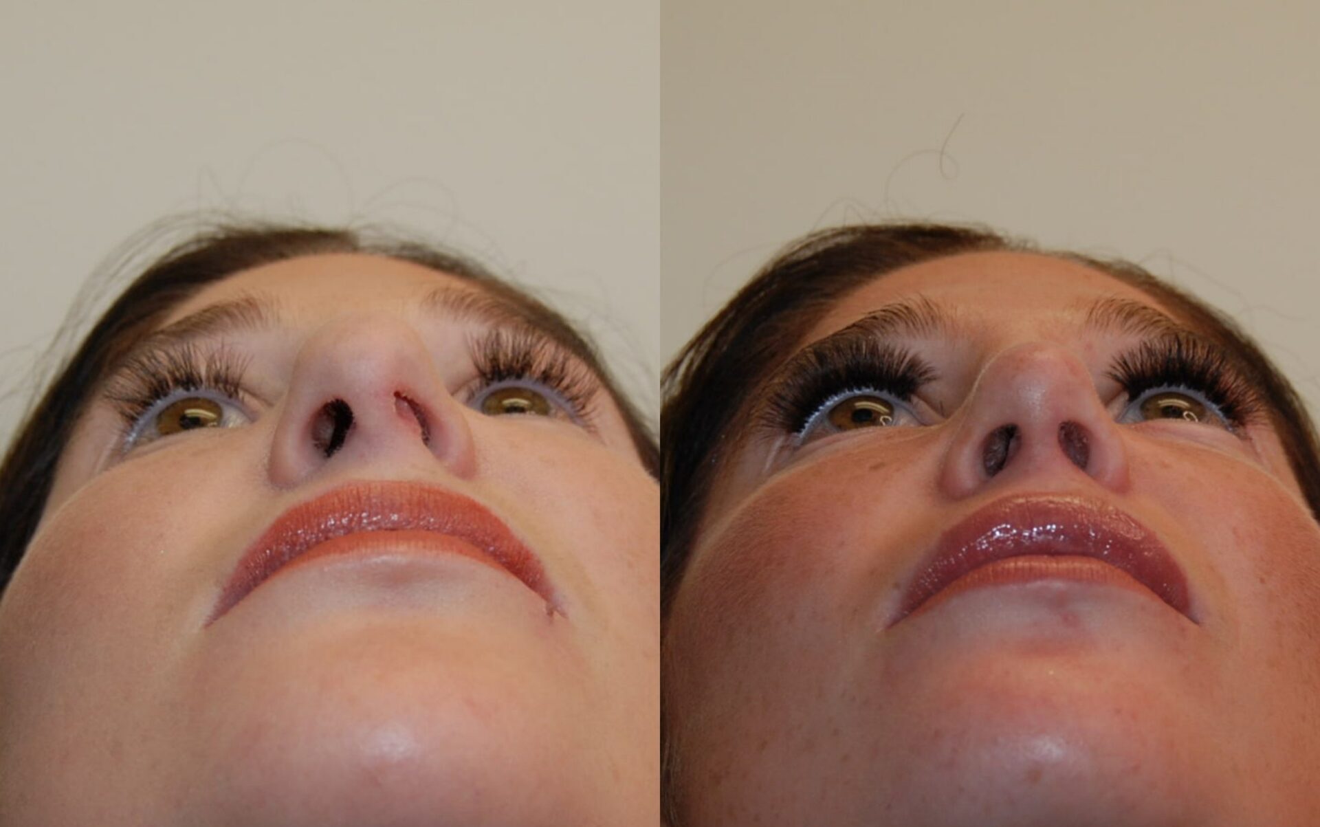 primary rhinoplasty & tip plasty for sub nose fixation