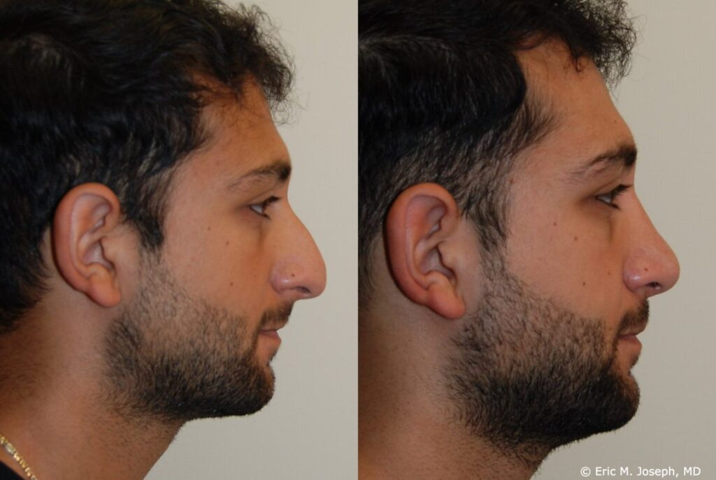 Snub nose rhinoplasty (nose job) before & after