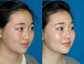 How to fix a flat nose without surgery? Nose Job or Liquid Rhinoplasty