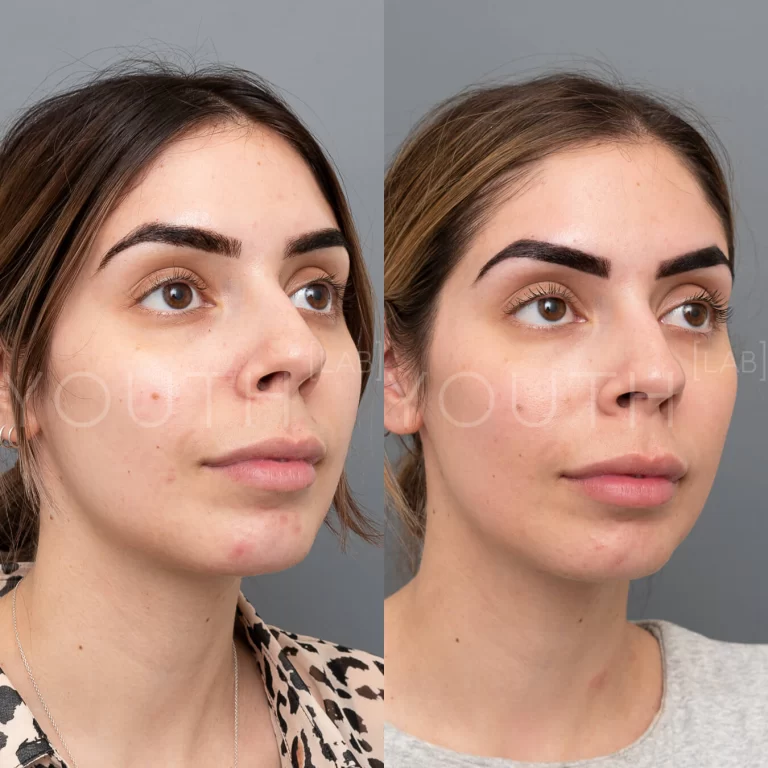 hydrafacial before and after