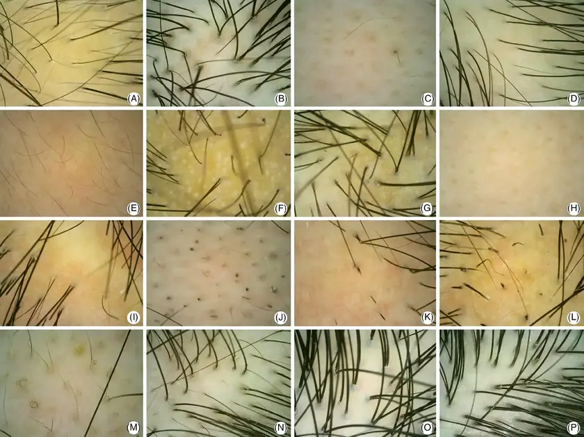 dermoscopic-findings-in-different-types-of-hair-loss-and-health-people-