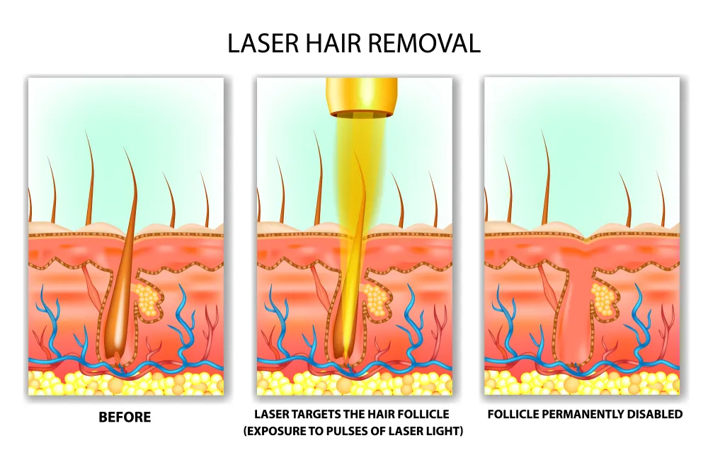 laser hair removal benefits price