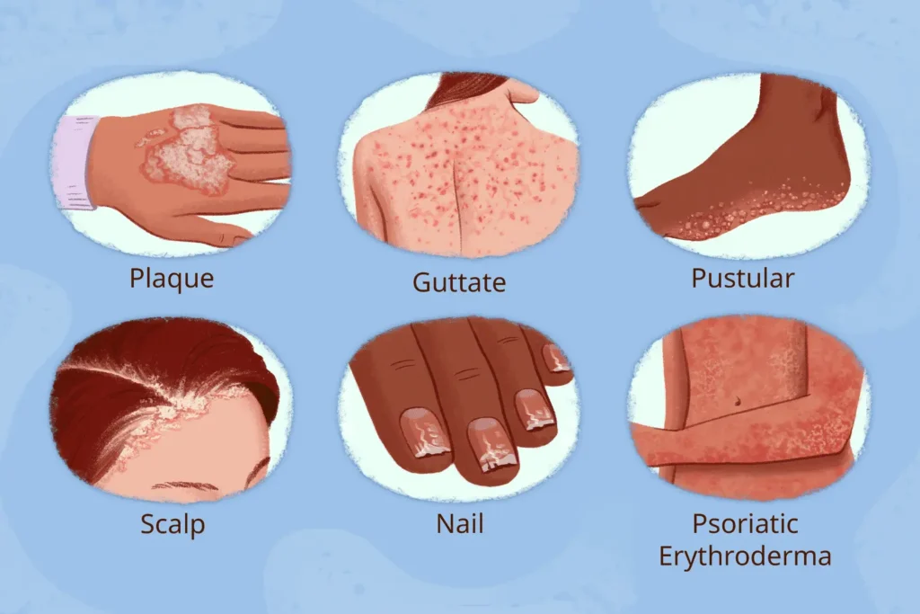 psoriasis, nail psoriasis, pustular psoriasis types