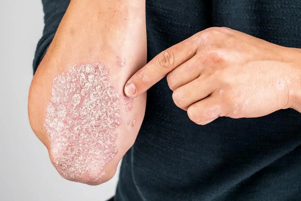 psoriasis vs eczema